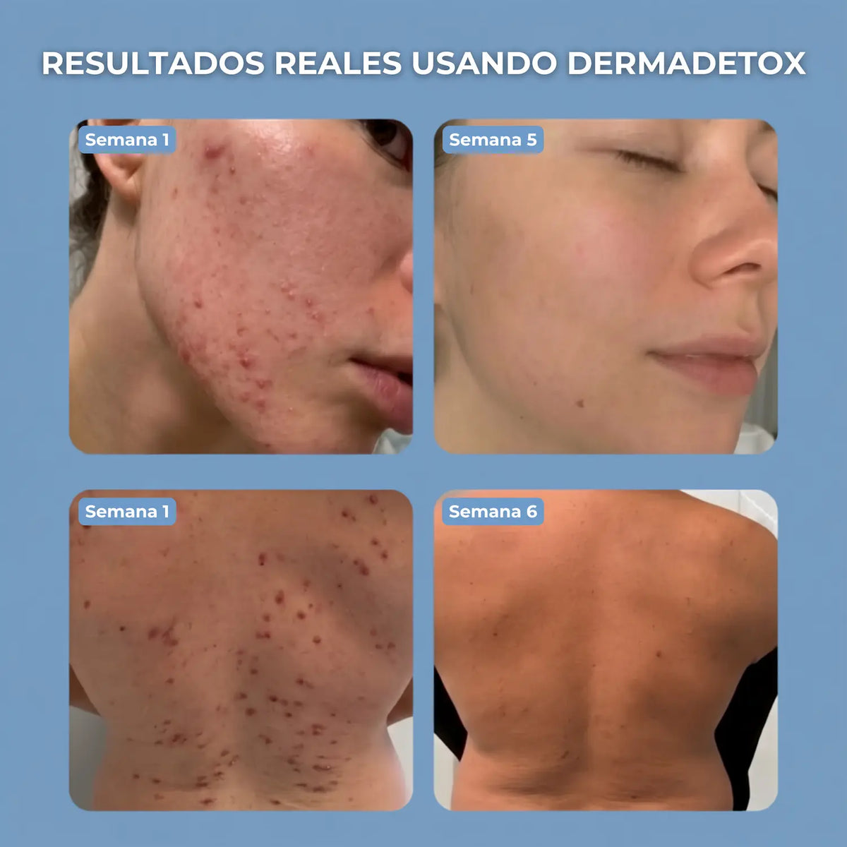 DermaDetox™ - Barra Antiacné para Rostro y Cuerpo